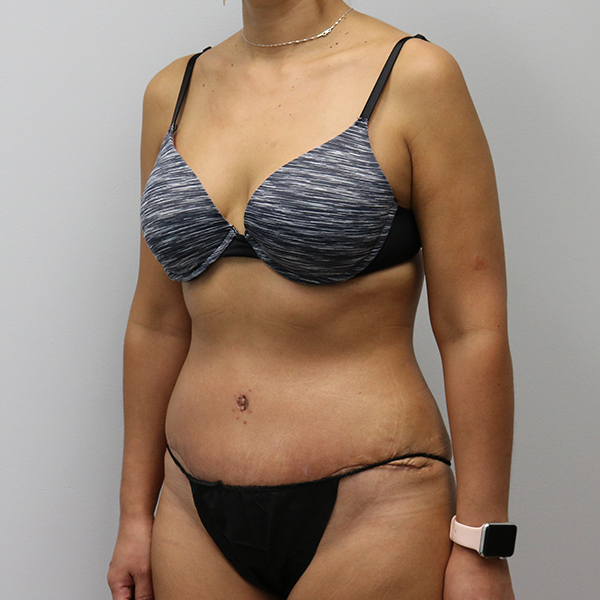 after tummy tuck left angle view of female patient case 2675