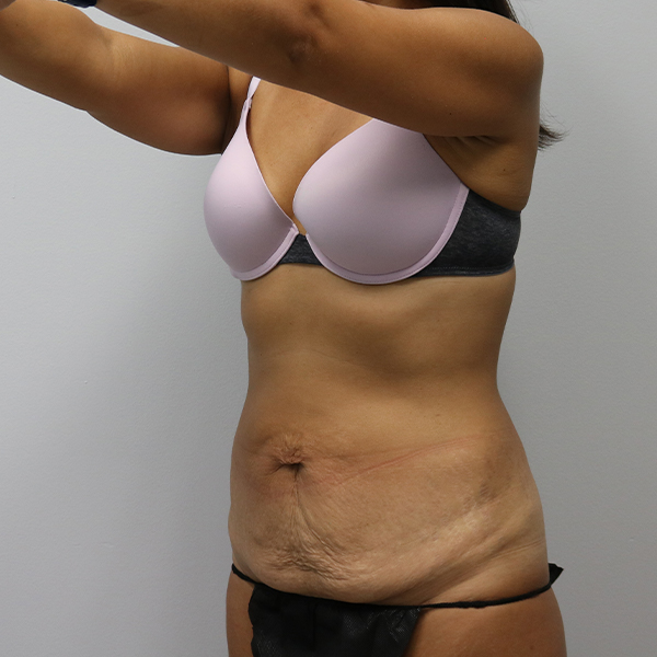 before tummy tuck left angle view of female patient case 2675