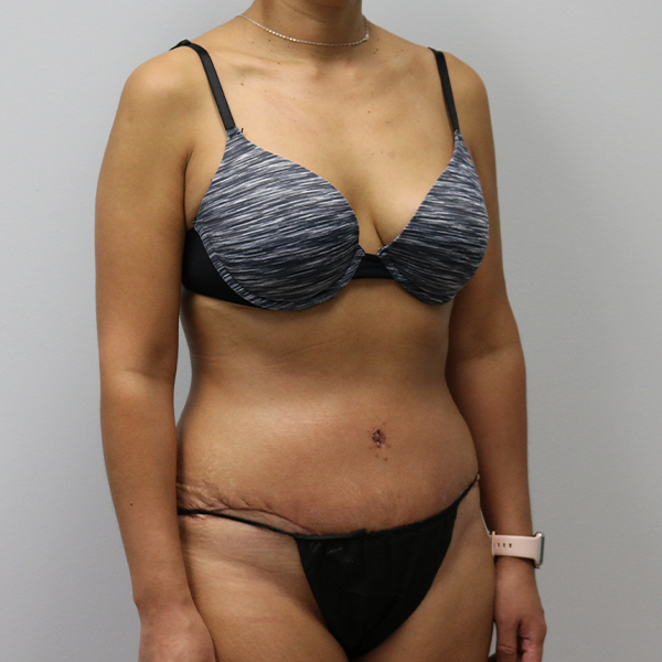 after tummy tuck right angle view of female patient case 2675