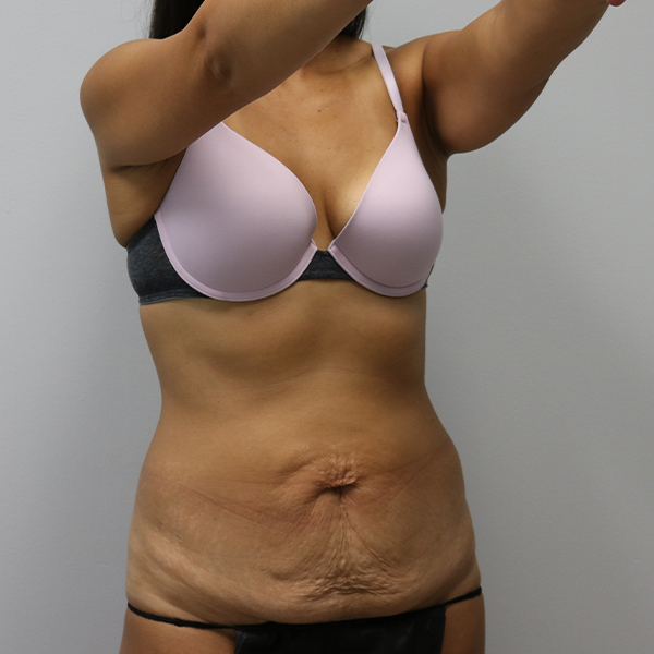 before tummy tuck right angle view of female patient case 2675