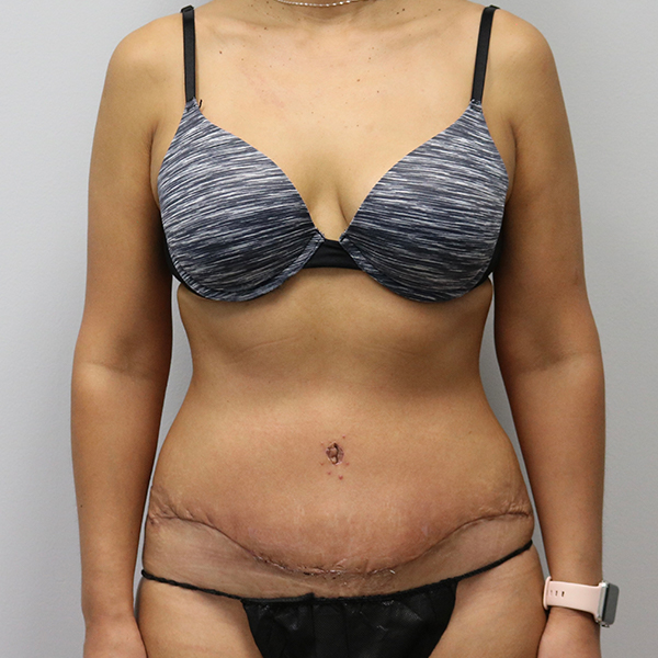after tummy tuck front view of female patient case 2675