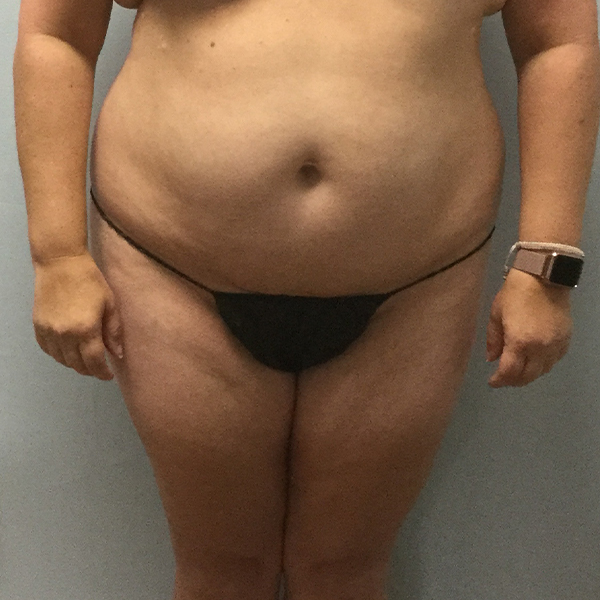 before tummy tuck front view of female patient case 2632
