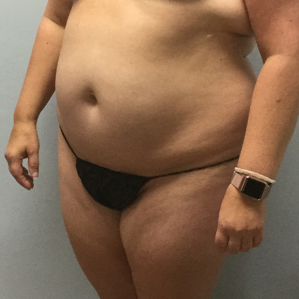 before tummy tuck left angle view of female patient case 2632