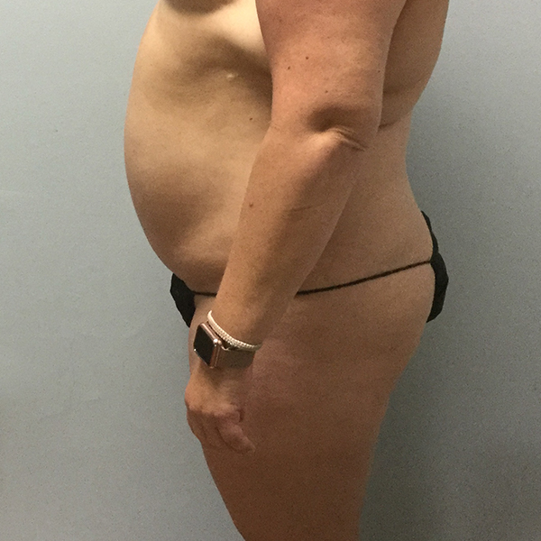 before tummy tuck left view of female patient case 2632