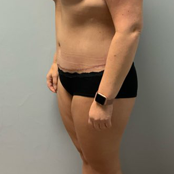 after tummy tuck left angle view of female patient case 2632