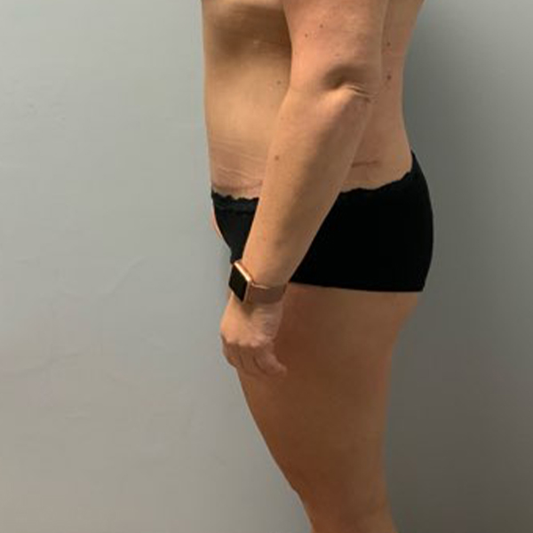 after tummy tuck left view of female patient case 2632