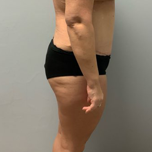 after tummy tuck right view of female patient case 2632