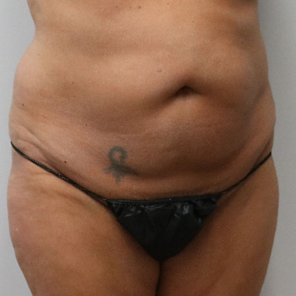 before tummy tuck female patient right angle view view case 2654
