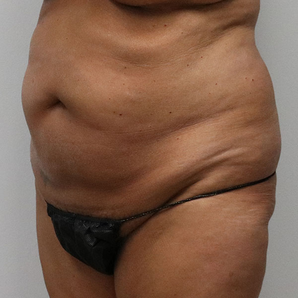 before tummy tuck female patient left angle view view case 2654