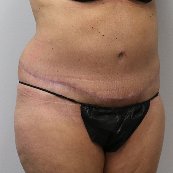 after tummy tuck female patient right angle view view case 2654