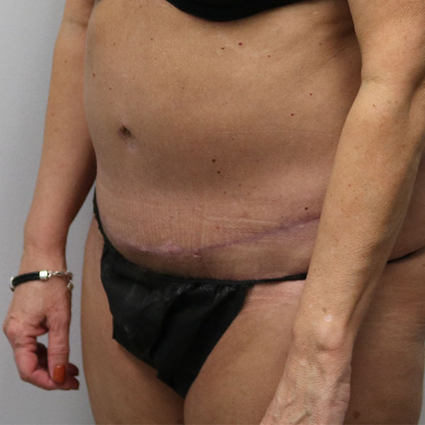 after tummy tuck female patient left angle view view case 2654
