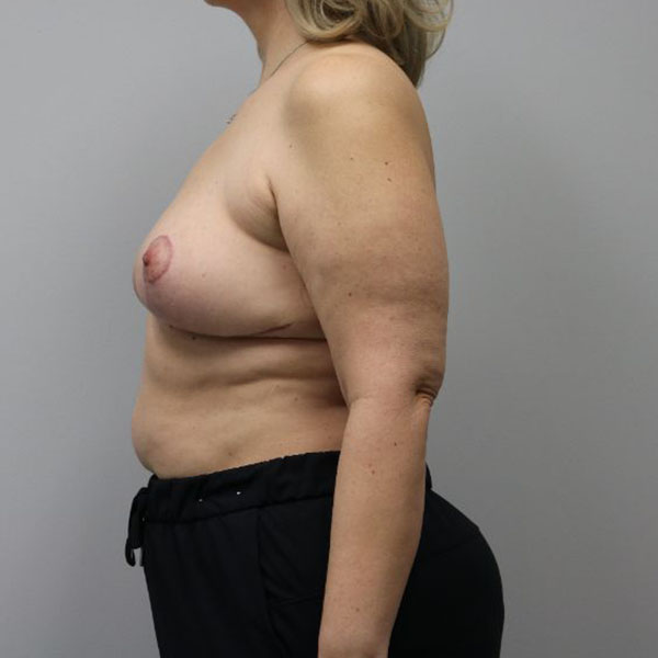 after breast lift to fix shape and position left side view female patient case 3885