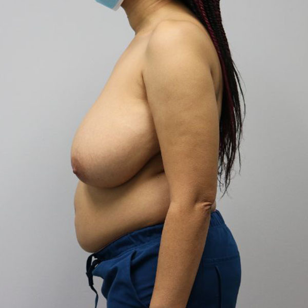 before breast lift to fix asymmetry female patient left side view case 3907