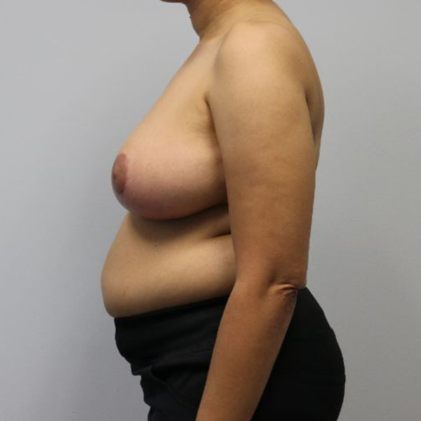 after breast lift to fix asymmetry female patient left side view case 3907