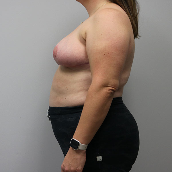 after breast lift in female patient left side view case 4322