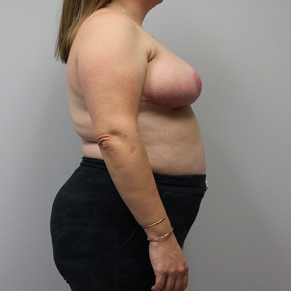 after breast lift in female patient right side view case 4322
