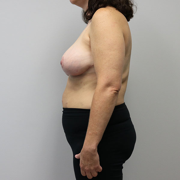 after breast lift in nashville female patient left side view case 4334
