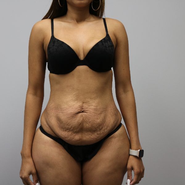 before tummy tuck female patient front view case 4390