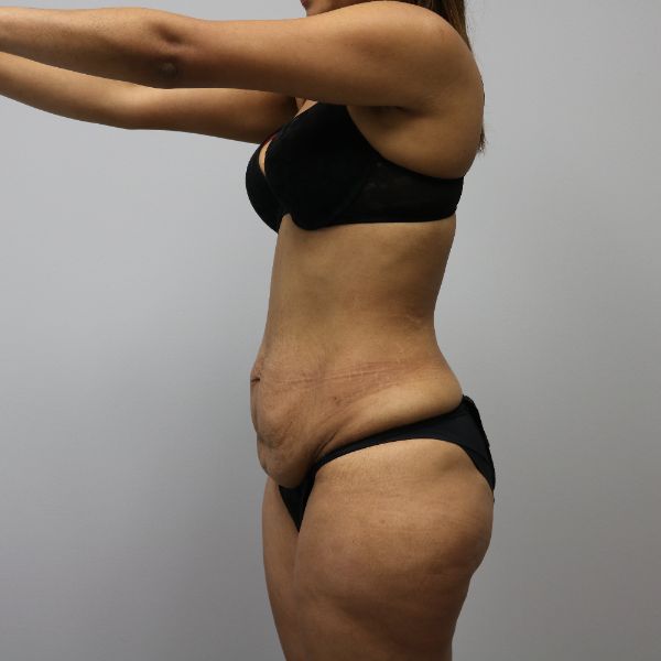 before tummy tuck female patient side view case 4390