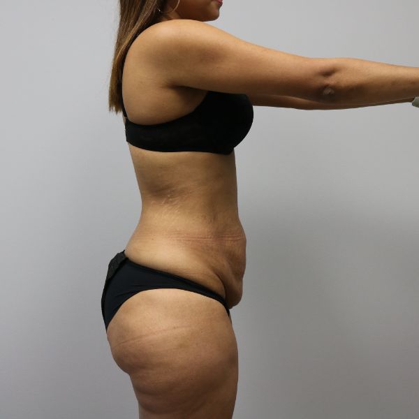 before tummy tuck female patient right side arms up view case 4390